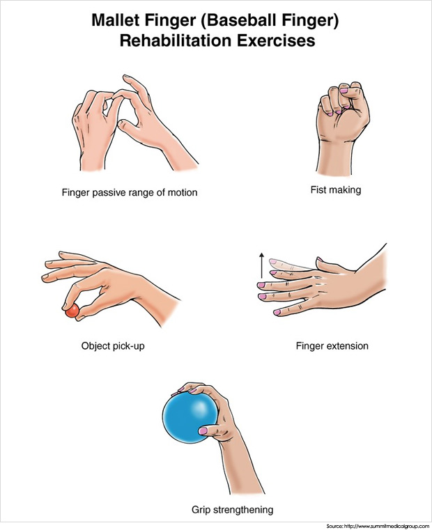 mallet-finger-exercises