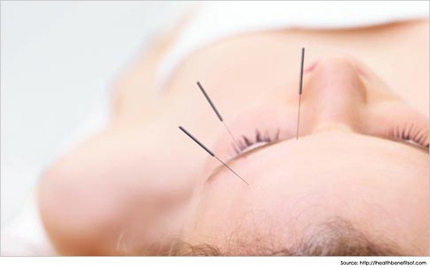 acupuncture-for-migraines-and-headache